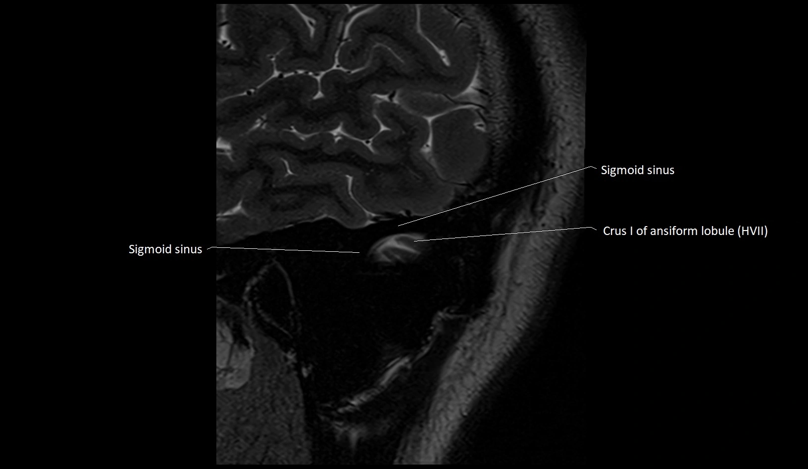 MRI Cerebellar anatomy sagittal High-resolution labelled image 1.webp